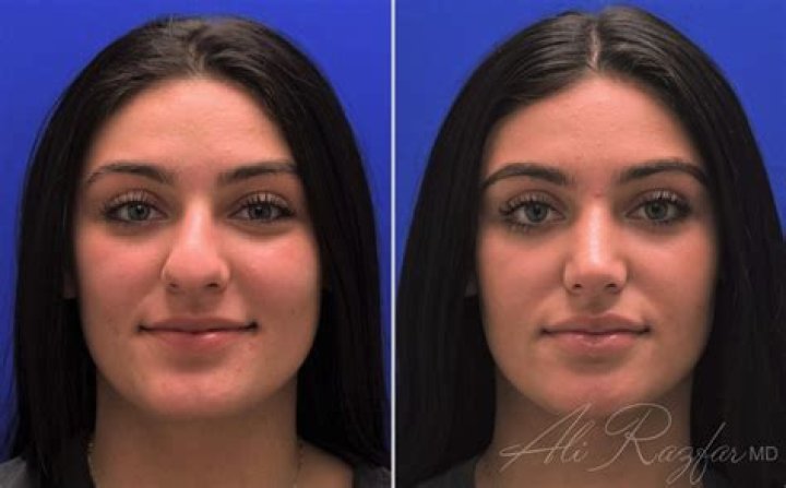 Alanna Panday's Nose Job: Before And After Transformation