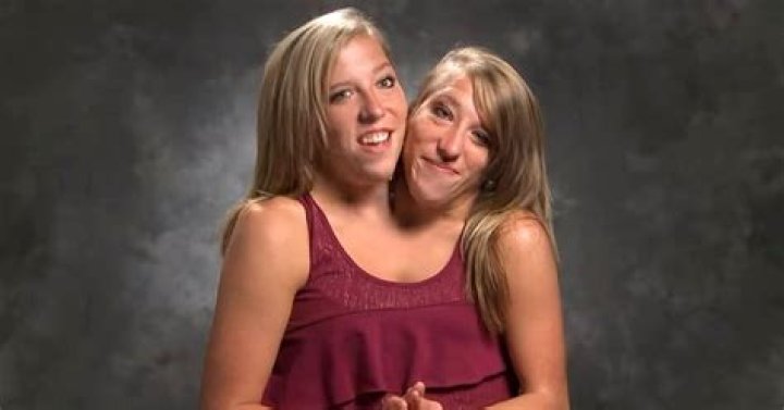 Are Conjoined Twins Abby And Brittany Still Alive? A Journey Of Resilience