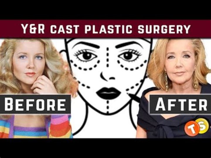 Uncovering The Truth: Did Sharon On Young And Restless Undergo Cosmetic Enhancements?