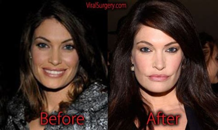 Unveiling The Truth Behind Kimberly Guilfoyle's Botox Journey