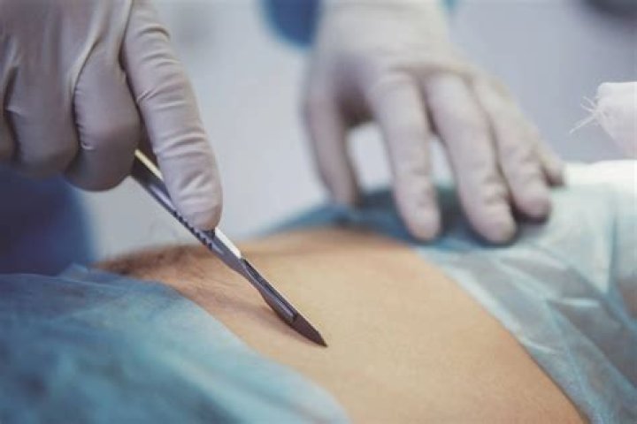 Liposuction In Sioux City: Transforming Lives And Bodies