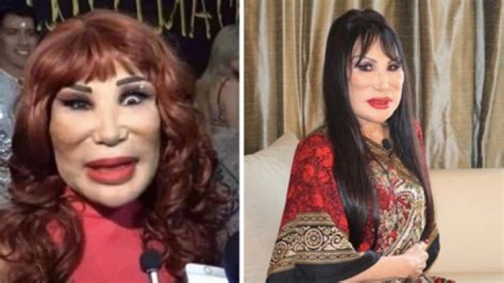 Lyn May And Her Journey With Botox: A Look At Beauty And Transformation