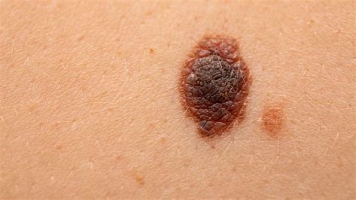 Understanding Melanoma: A Comprehensive Guide To Skin Cancer